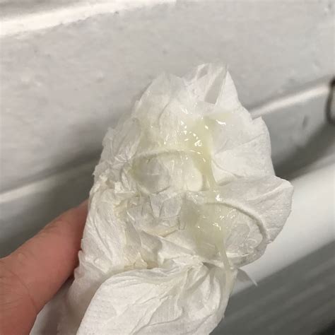 a blocked or enlarged milk duct. . Slight yellow discharge reddit
